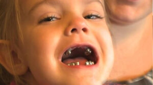 Why Kids Get Silver Teeth