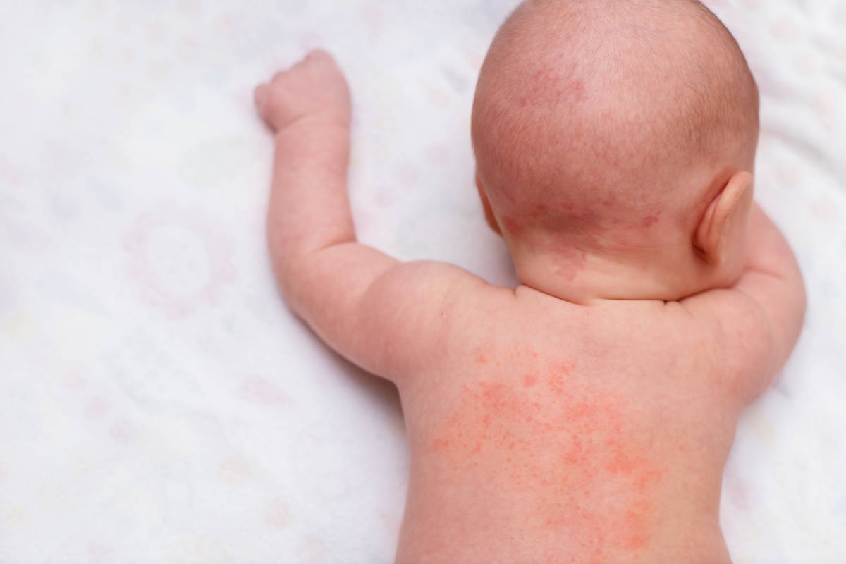 What Causes Hives in Kids: Ultimate Guide to Manage The Hives of Your ...