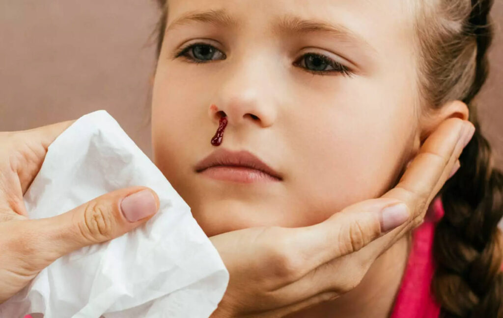 what-causes-nosebleeds-in-kids-ultimate-guide-about-childhood